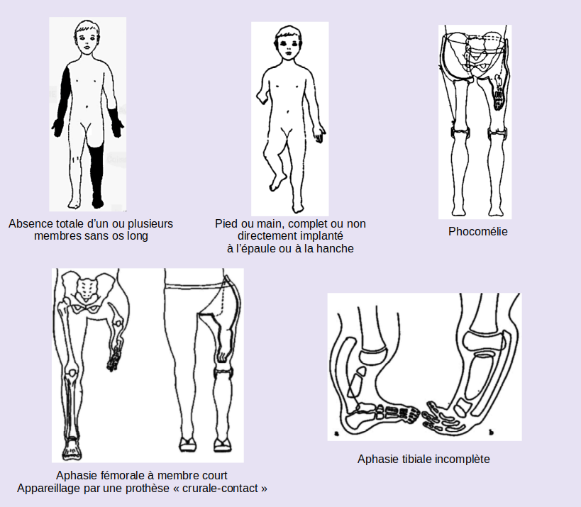 amputations-congenitales