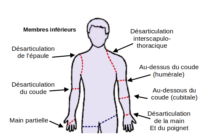 Amputations du membre supérieur