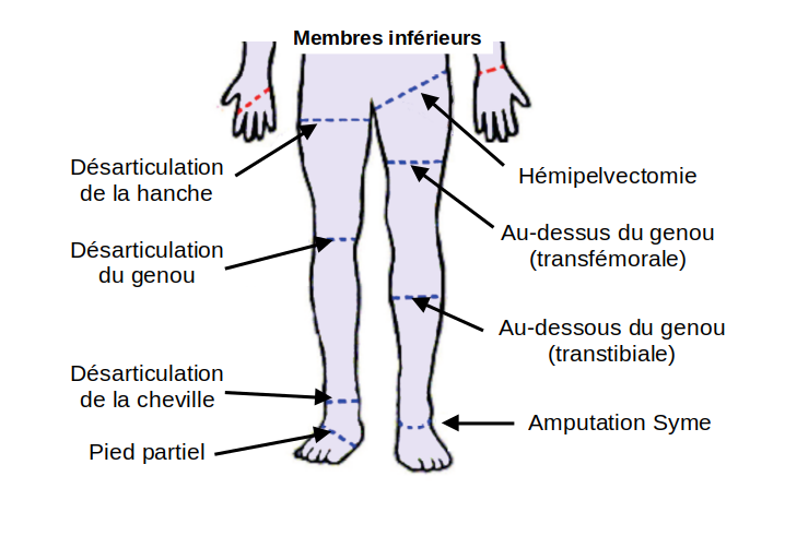 Amputations du membre inférieur